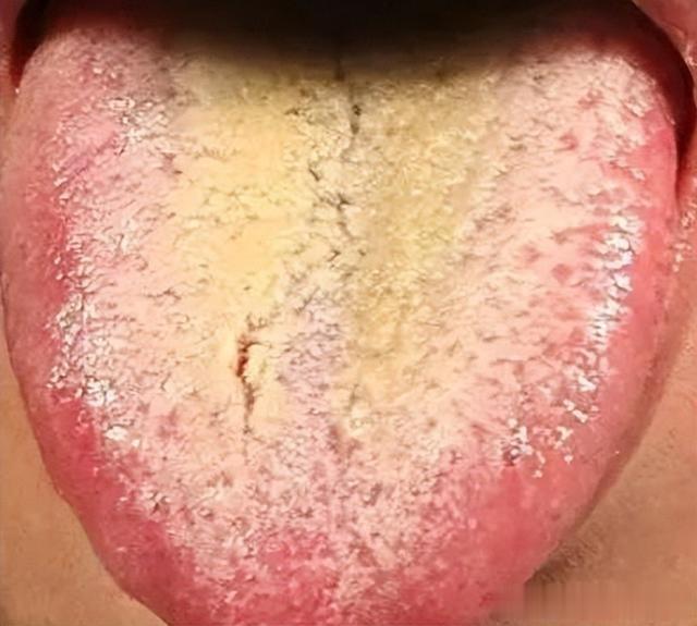 疾病|舌头中间有裂纹,边缘有齿痕等,是大病征兆?现在知道还不晚!