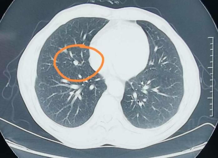 女子查CT发现肺结节，复查时结节几乎消失，或因她平时常做4件事