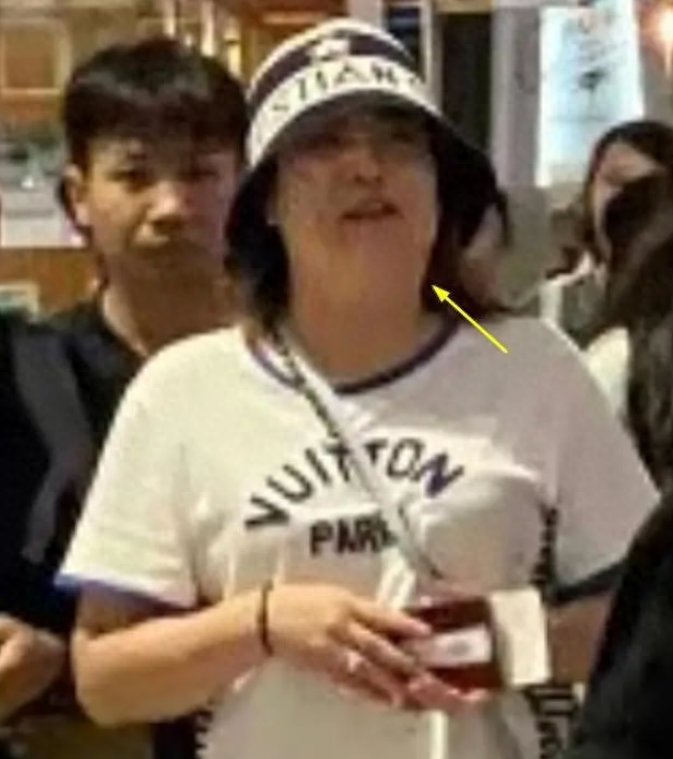 大张伟老婆现身英国,脖子肿胀似胖50斤,大张伟全程黑脸疑嫌弃