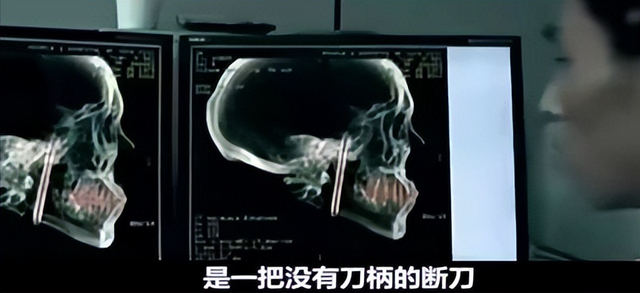 男子口臭骇人,每天刷牙数十遍都没用,检查发现颅内有10公分刀片