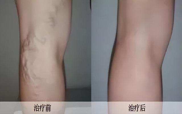 小腿上的“小蚯蚓”是病！治疗方法在这里