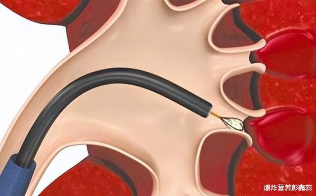 为什么越来越多的人不喜欢喝自来水，自来水水垢到底有多伤身体？