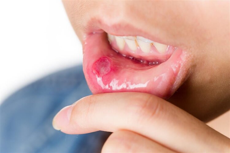 体内有癌，嘴先知？提醒：口腔出现这4种症状，可能是癌症在靠近