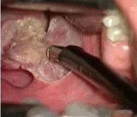 |儿童打鼾危害大,早期治疗效果好,扁桃体和腺样体切除术释疑