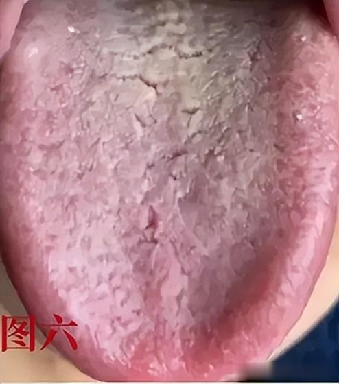 9种舌象9种体质,看镜子自查,学会了,不走弯路!