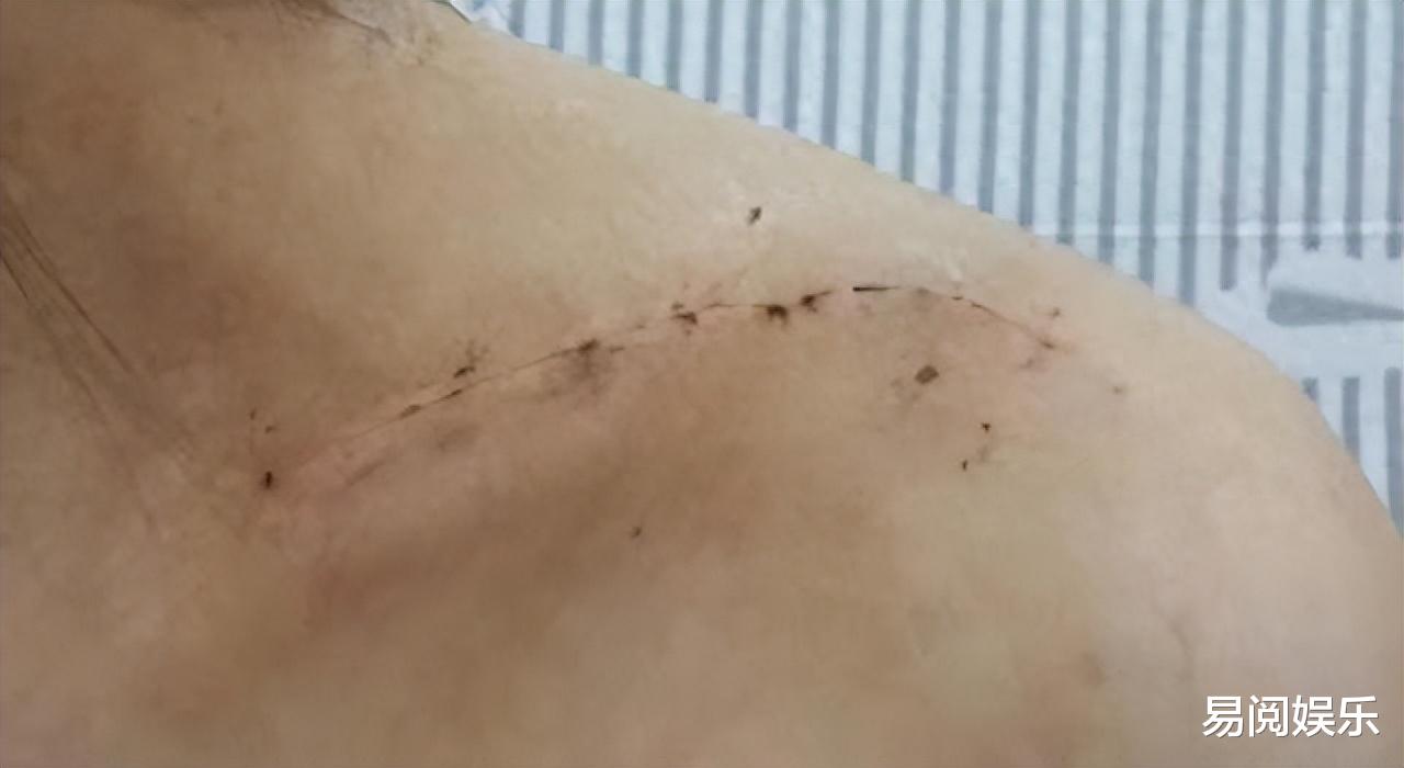 偶像男星爆雷，砸断女演员锁骨被控诉，内涵男方越混越差