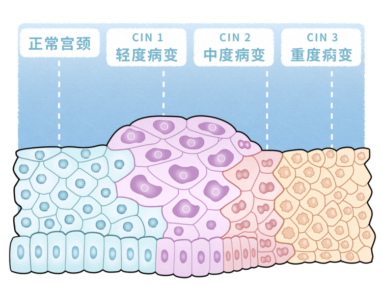 提醒：中老年女性“倒开花”，可能不是重返青春，而是癌症的预警