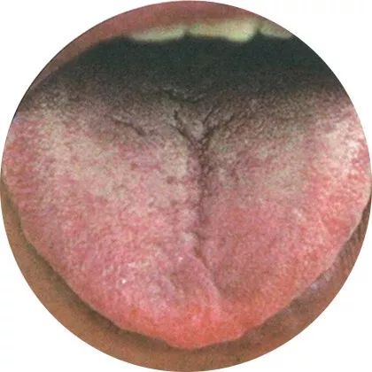 失眠|中医中的舌诊,了解吗