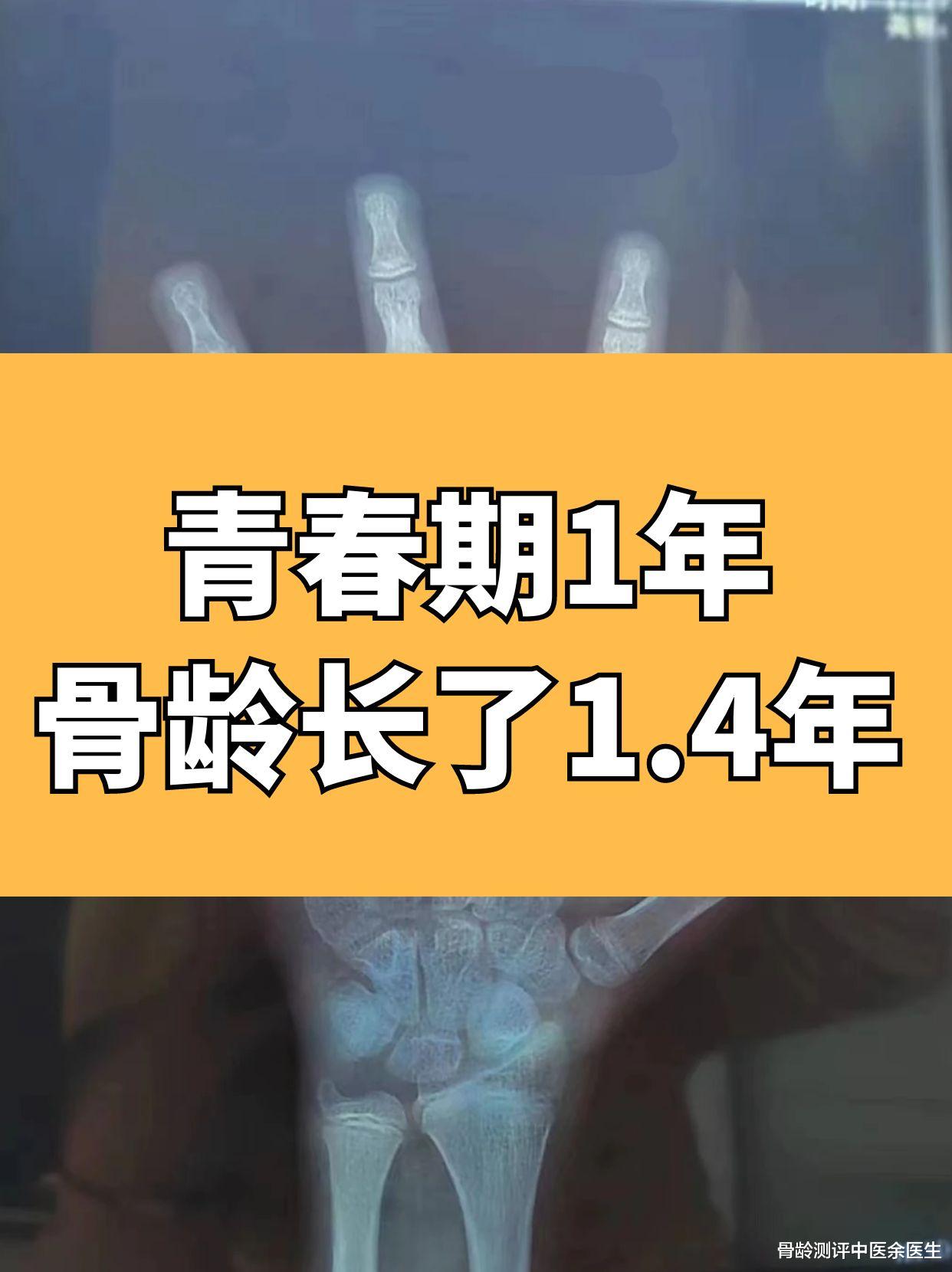 |青春期1年,骨龄长了1.4年