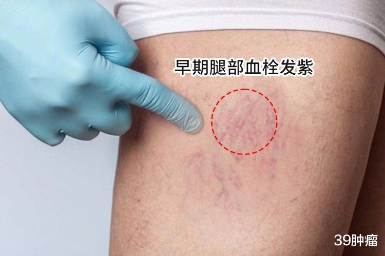 腿是血栓“报警器”？提醒：若有这4个表现，要怀疑血栓或已到来