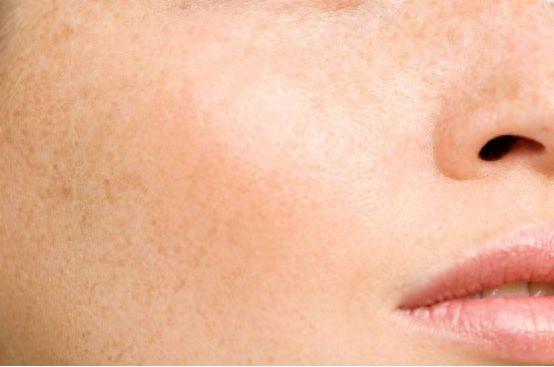 保持正确的生活习惯，让色斑慢慢远离你