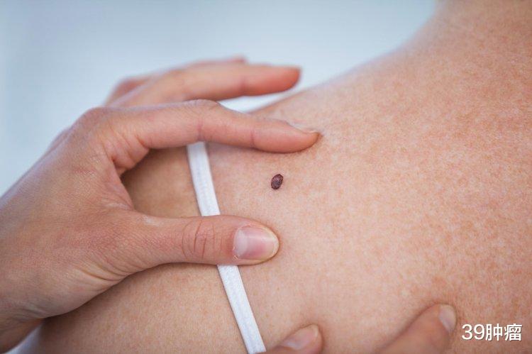 黑色素瘤|一再提醒:痣长在这3个位置,与癌症“密不可分”,赶紧自查