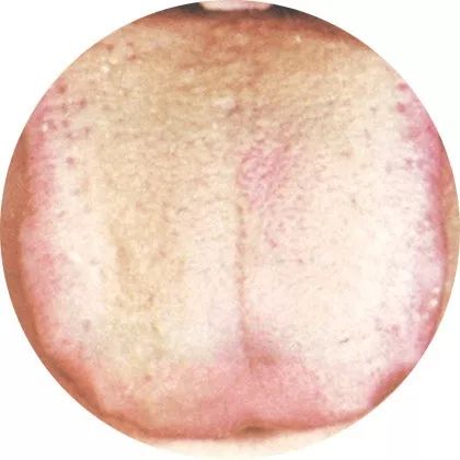 失眠|中医中的舌诊,了解吗