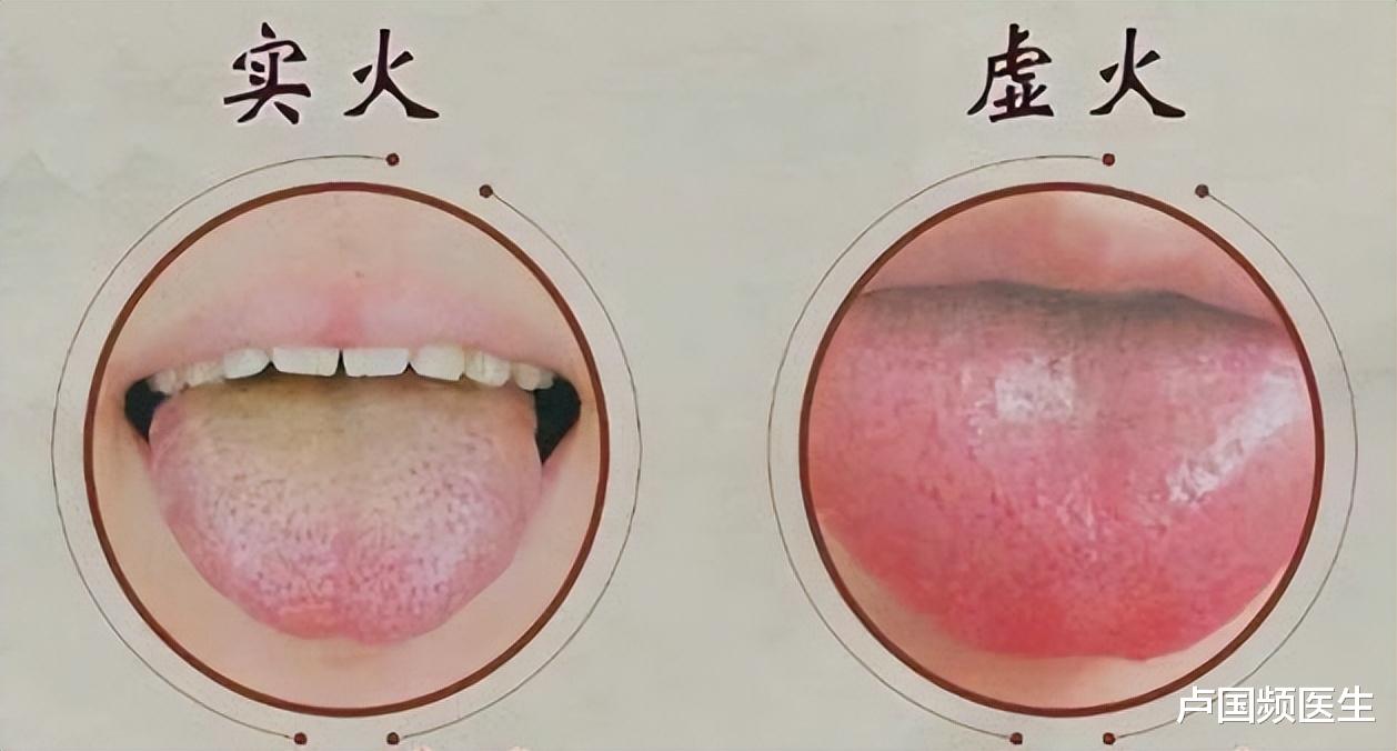 肺火、心火、胃火、肝火、肾火，别管什么火，总之你上火了！