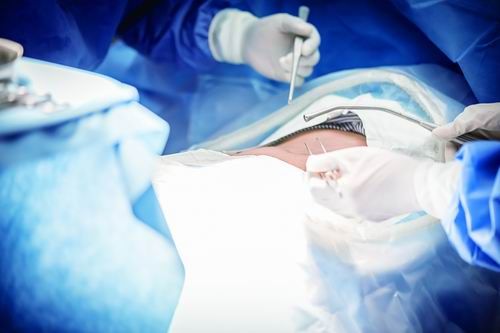 膀胱癌|加速康复外科迎来“提质增效”时代