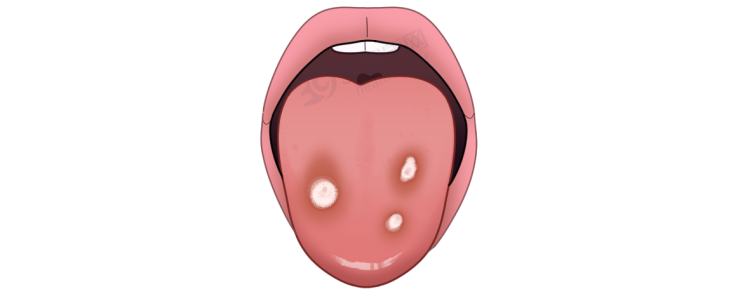 体内有癌,舌头先知?若舌头出现7种异常,当心癌症或疾病预警