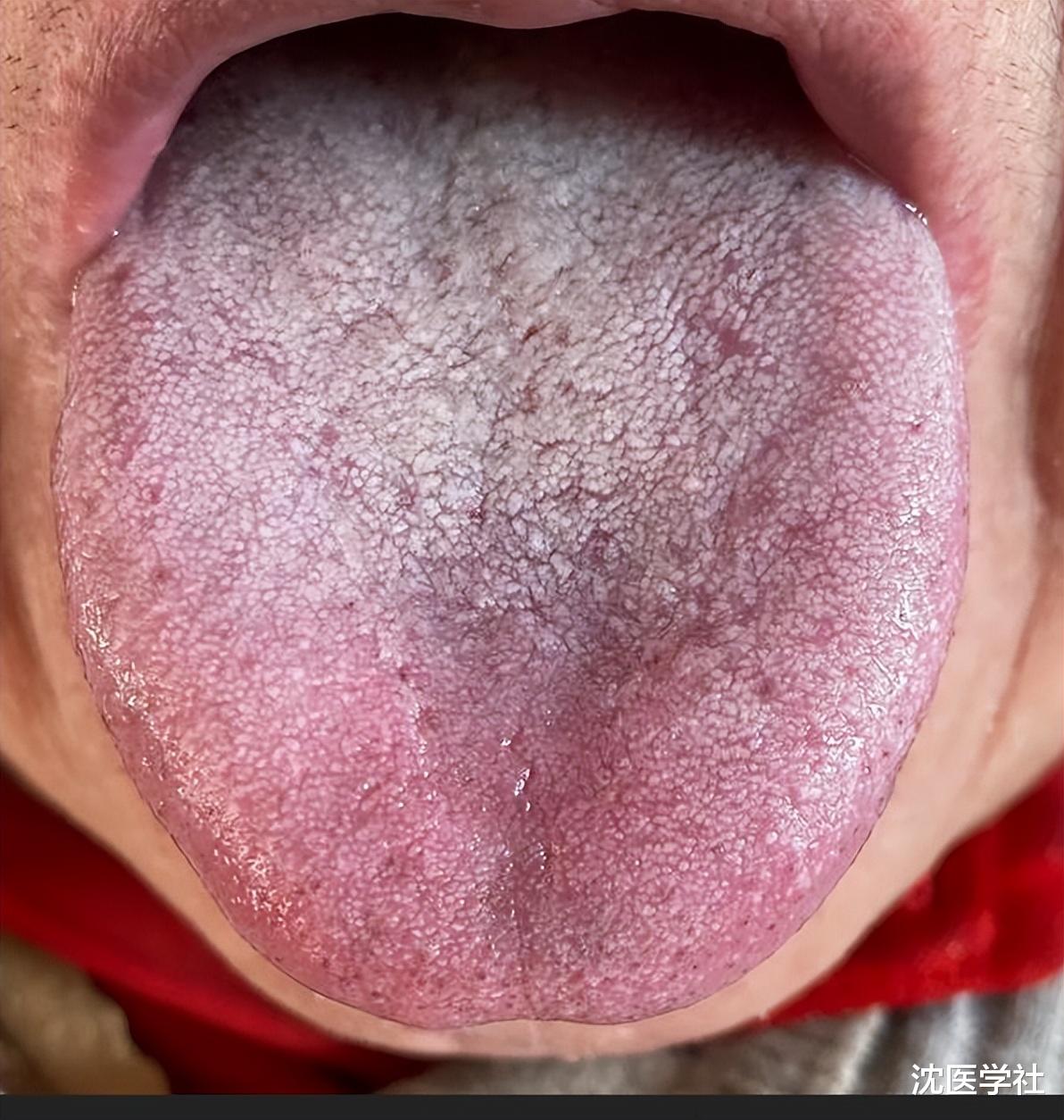 失眠在痰，手脚麻木在痰，小腹肥胖还在痰！一个药，横扫一身痰湿