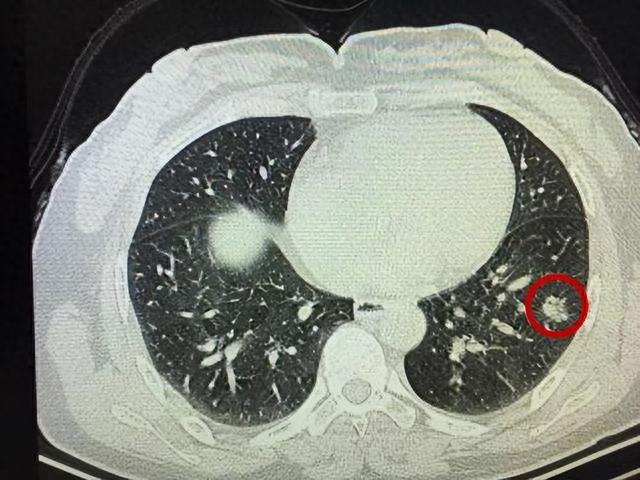 大蒜，是肺结节“催命符”吗？医生：不想结节癌变，少碰“2味”