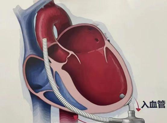 金樱子|59岁心功能22%呼吸困难随时猝死，植入我国人工心脏后心功能48%