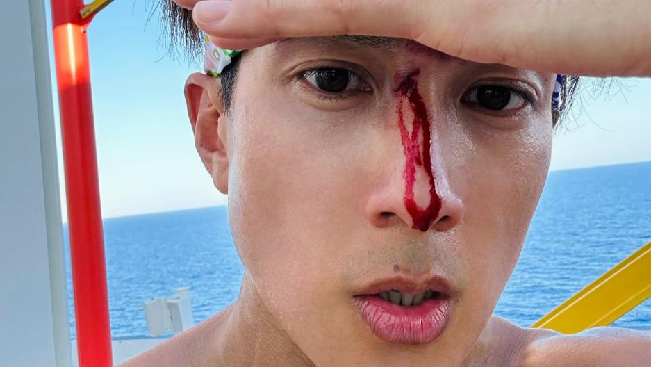 突发！吴尊七夕出国不慎受伤，称伤口深恐破相，儿女看热闹不关心