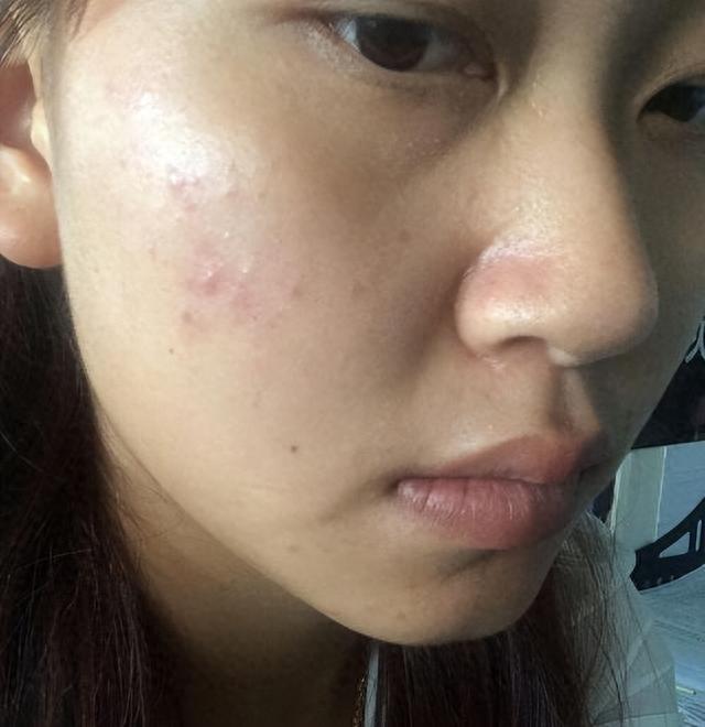 俗话说“肝火一烧，百病难熬”，肝火旺盛时，身体或有5种表现