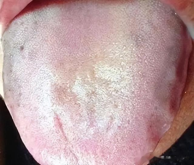 疾病|舌头中间有裂纹,边缘有齿痕等,是大病征兆?现在知道还不晚!