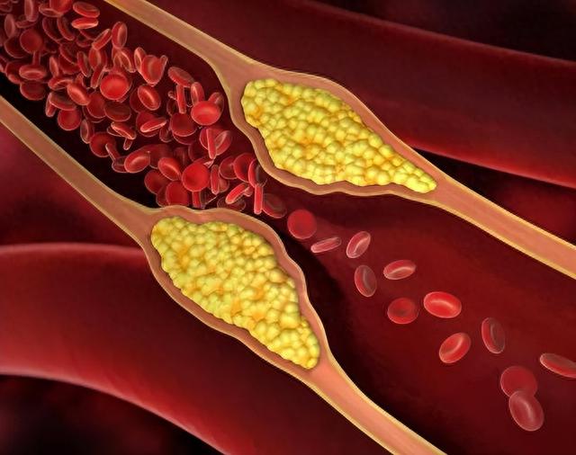 玉米是高血脂的“发物”？医生：若想降低血脂，3种素食尽量远离