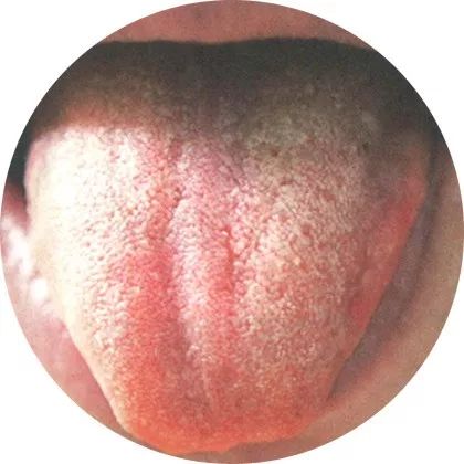 失眠|中医中的舌诊，了解吗