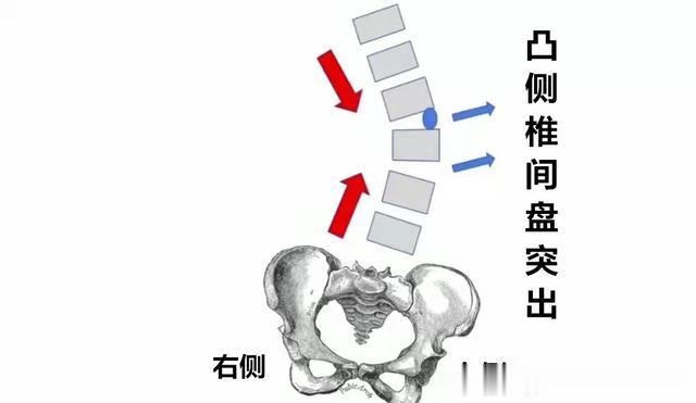 二手烟|腰椎间盘突出,是选择保守治疗?还是手术?