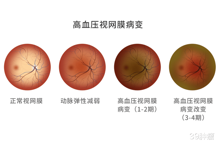 实锤!运动降压并非假话,研究已证明,这1种运动降压效果最好