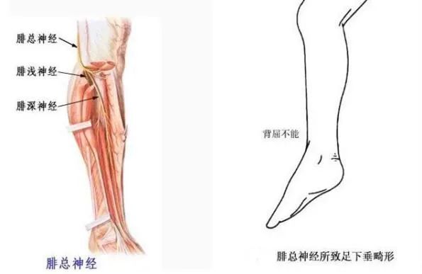 减重过快、跷二郎腿，小心足下垂