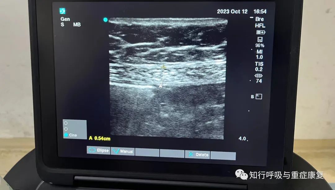 第148期 机械通气过程中腹肌超声的应用