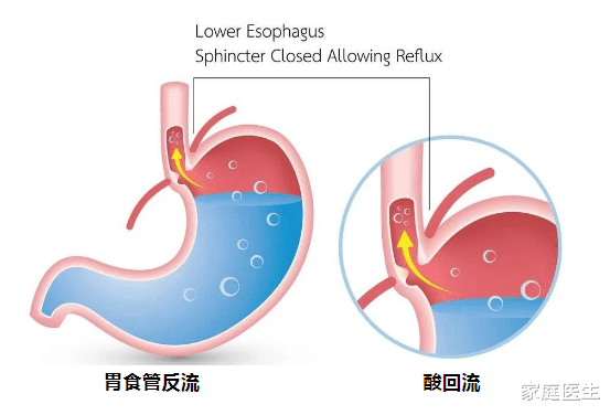胃酸|饭后反酸、烧心,是怎么回事?6种“烧心反酸”食物,千万要少碰