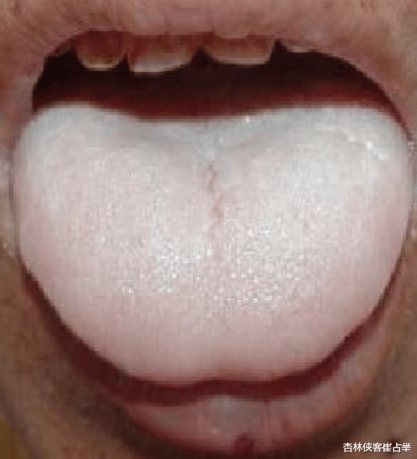 心脏|脾虚万病生,脾虚生湿生热、生寒生痰,肝郁脾虚如何参考中成药?