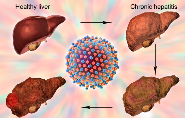 52岁男子，常用一“零嘴”当饭吃，谷丙转氨酶从260降到48