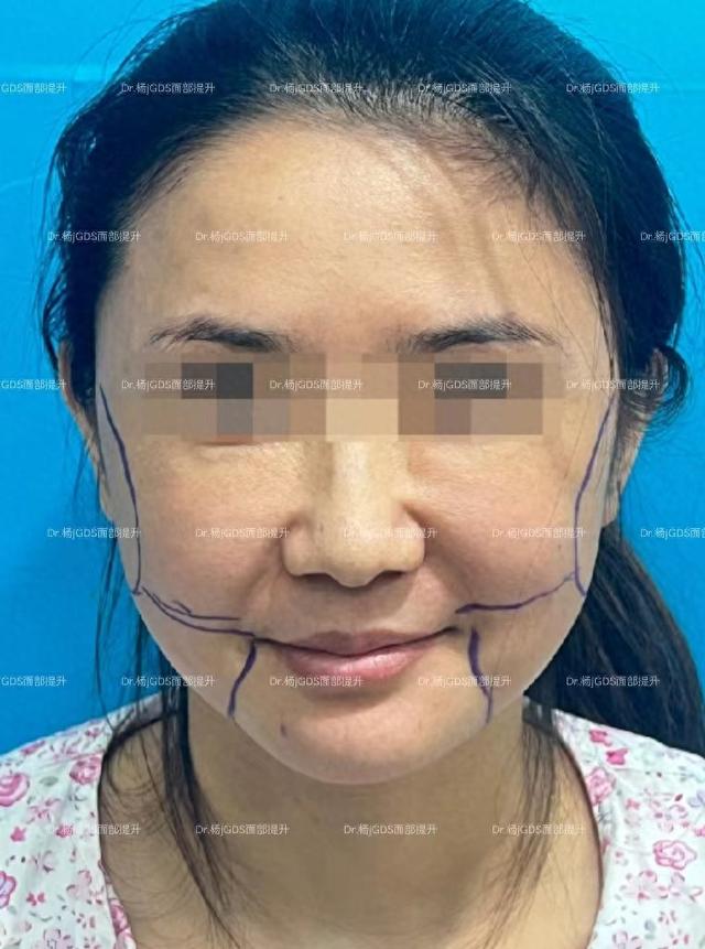 4、5个小时的手术，一周内大肿就消了，41岁女士谈小切口提升经历