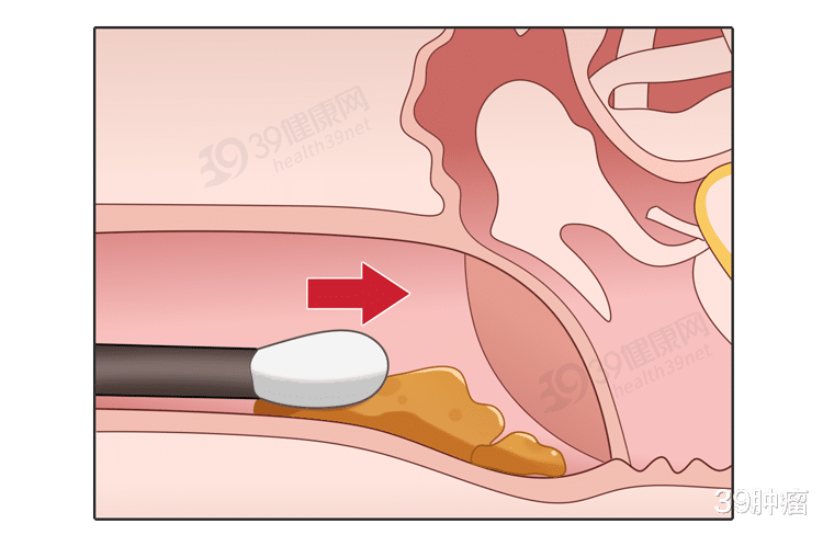 耳朵里面经常痒，却掏不出东西？或在暗示你这4个问题，别忽视了