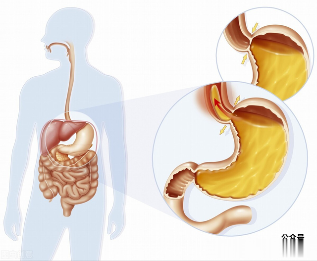 运动|分享一个验方专治慢性胃炎胃痛！关键只要几毛钱