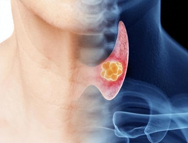 鸡蛋是甲状腺结节的“发物”吗？医生：保护甲状腺，5物要管住嘴