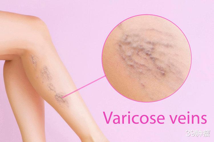静脉曲张|身上4个部位的“爆青筋”，或是身体的求救信号，及时检查