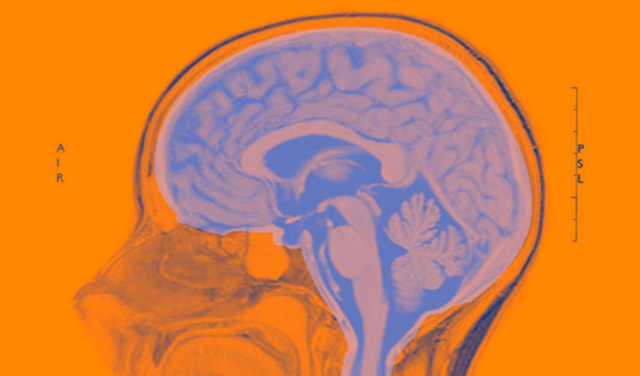 大脑|血型不同，大脑衰老速度不同？哪种血型容易得老年痴呆？研究来了