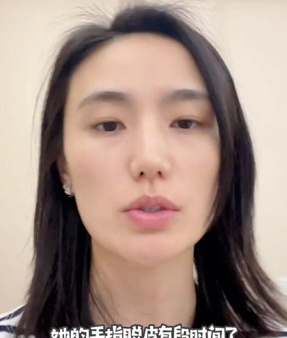 古力娜扎|又是先天病？李亚鹏二女儿长期手脱皮，海哈金喜脸憔悴眼神已无光