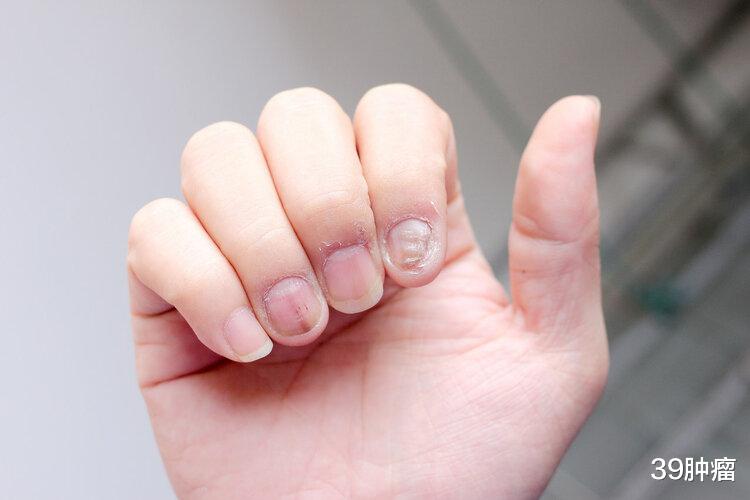 体内有癌,手脚先知?手脚若有这4个变化,很可能是肝癌发出信号