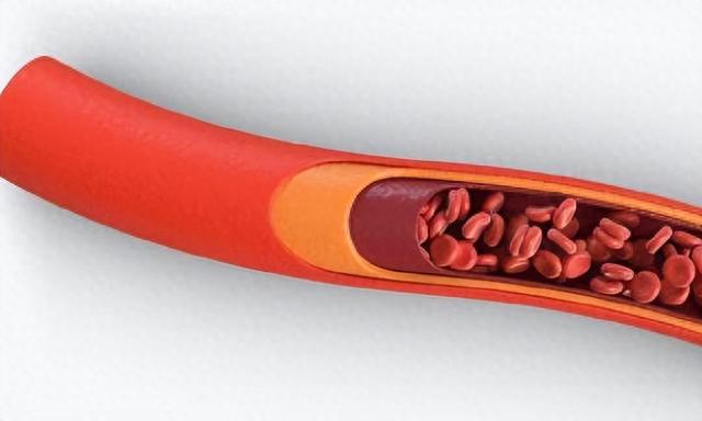 血液“稀释剂”被发现,柠檬水落榜,医生:坚持喝血管变通透