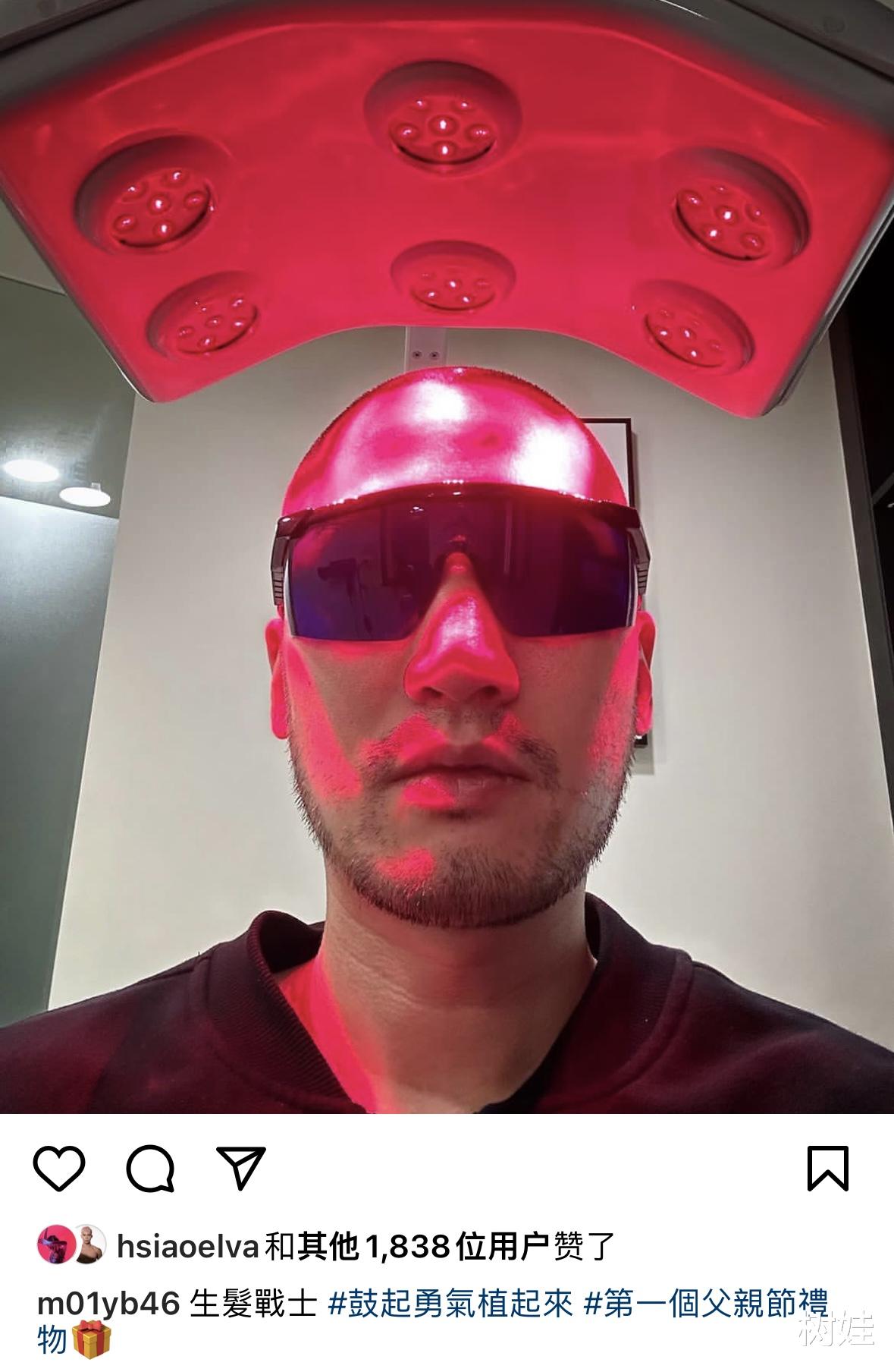 钟欣潼34岁前夫自曝头发少,公开植发治疗照,靠发型帽子遮挡秃头