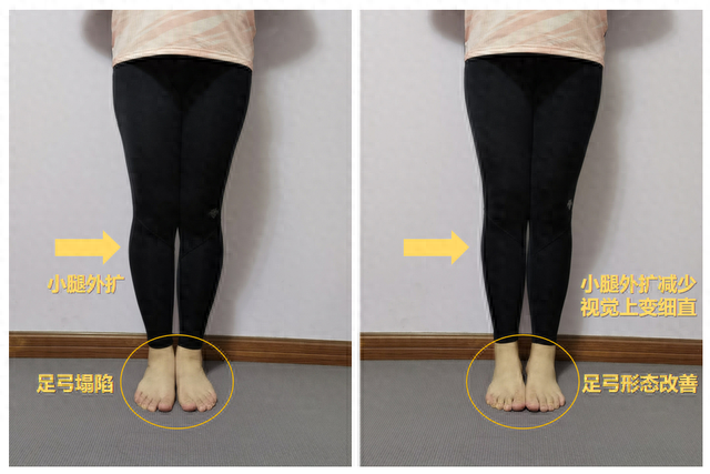 骑车会不会粗小腿?浙大二院骨科运动医学专科的医生告诉你如何运动瘦小腿?