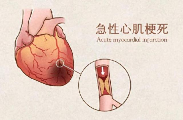 装上心脏支架后，还能活多少年？医生不再隐瞒，说出答案
