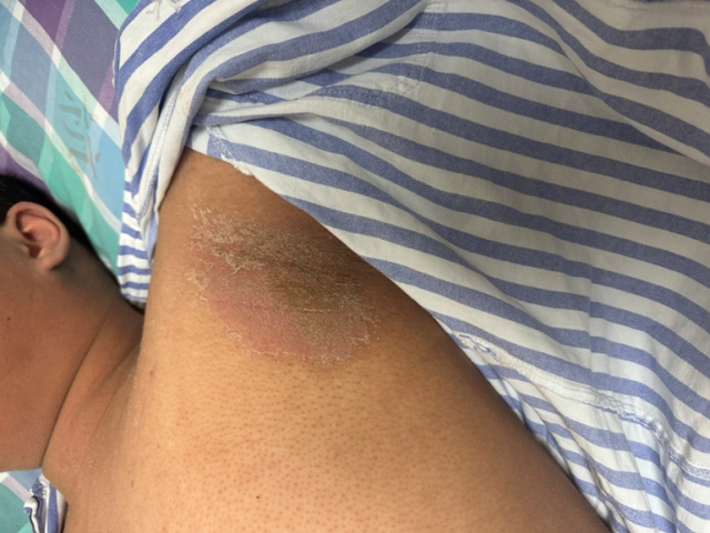 过敏|初三男生全身皮肤溃烂,竟是因为吃了这种水果!