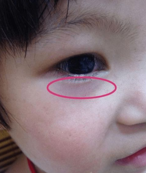 下眼睑代表着脾胃,颜色发青发紫发黑是寒,发红是有热的表现.