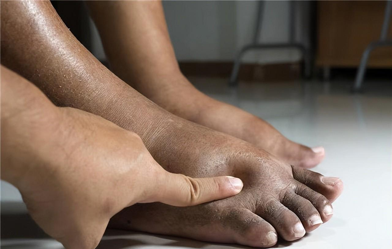 脑积水|40岁男子痛风发作，查出肾衰竭，提醒：2种食物加速恶化，管住嘴